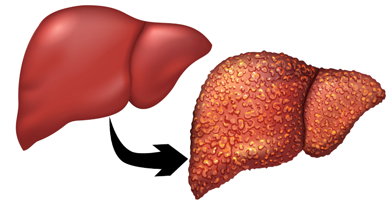 Redbull Destroyed this Woman&rsquo;s Liver! - DavidWolfe.com